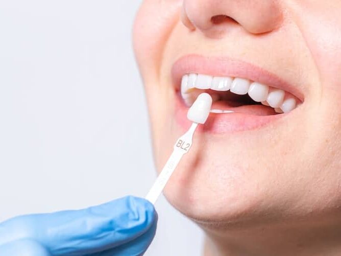 A closeup view of a woman's mouth while a dentist applies a dental veneer