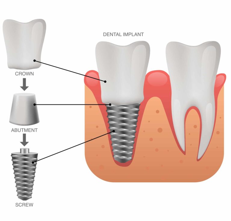 A graphic showing the different parts of a dental implant