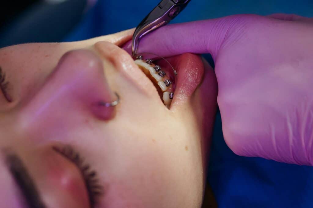 Young woman with nose-ring is seen with orthodontist's gloved finger moving to apply dental braces on her lower teeth.
