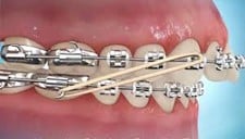 Animated image of Class 2 elastics for orthodontic rubber band placement.