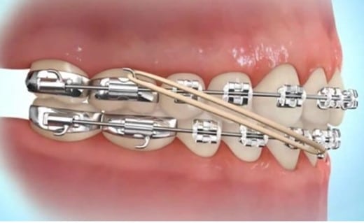 Animated image of Class 3 Elastics for orthodontic rubber bands.