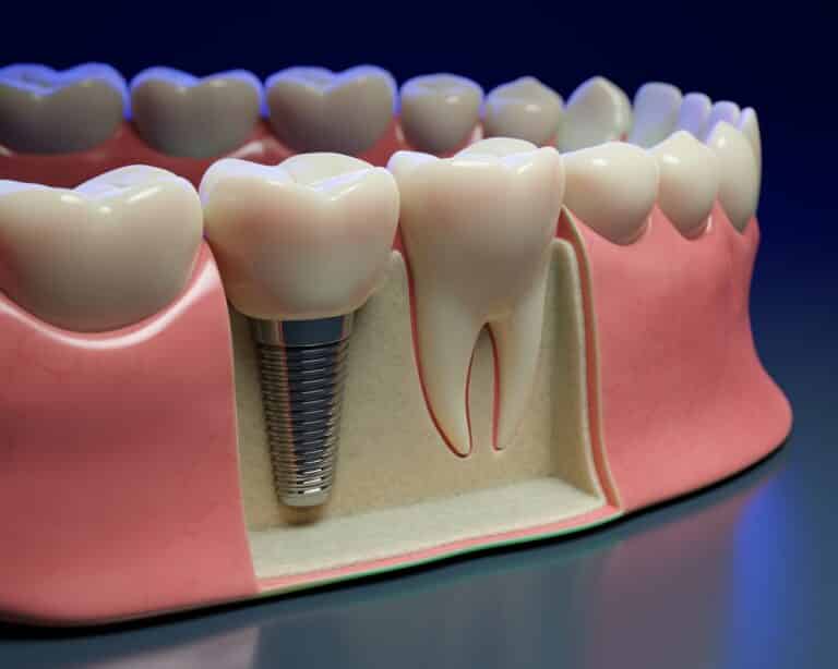 Graphic showing how a dental implant is placed in a jaw next to an example of a real tooth