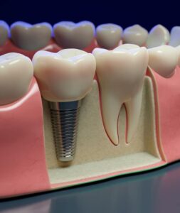 Graphic showing how a dental implant is placed in a jaw next to an example of a real tooth