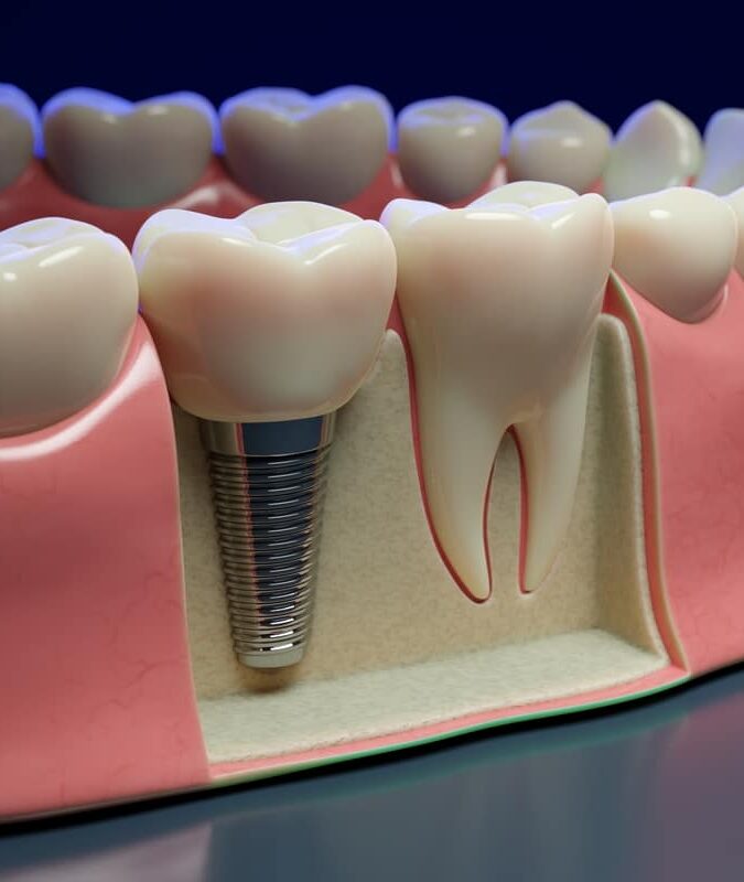 Graphic showing how a dental implant is placed in a jaw next to an example of a real tooth