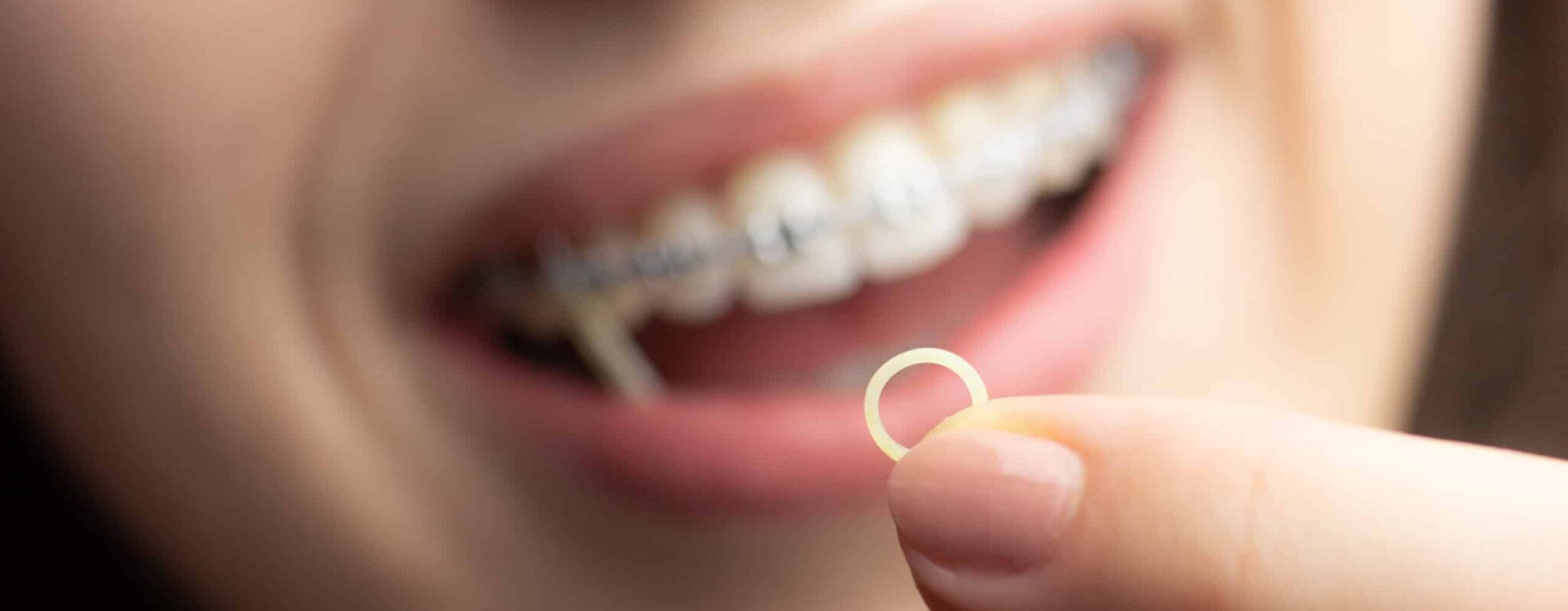 Closeup of a woman with braces wearing power chains and orthodontic elastics to correct her bite.