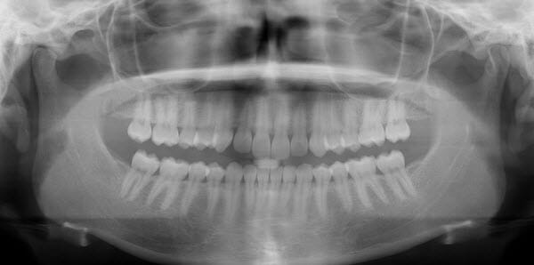 xray of a 2d image scan of teeth