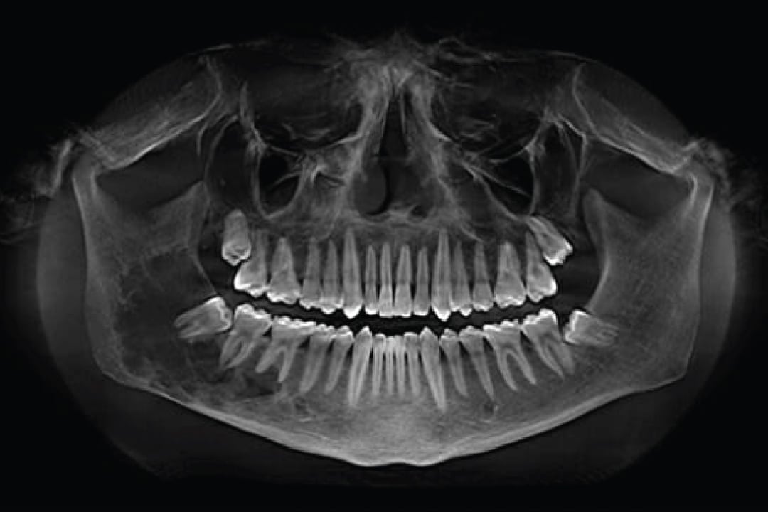 Mouth x-ray