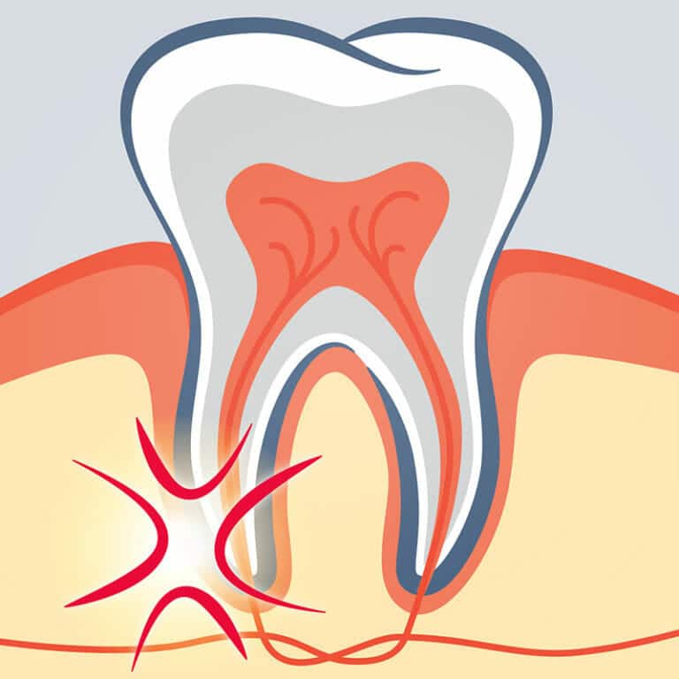 Illustration of a tooth with a root issue