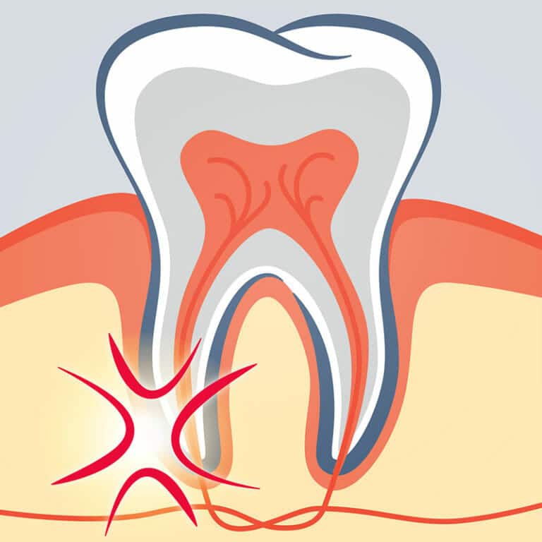 root canal cartoon drawing