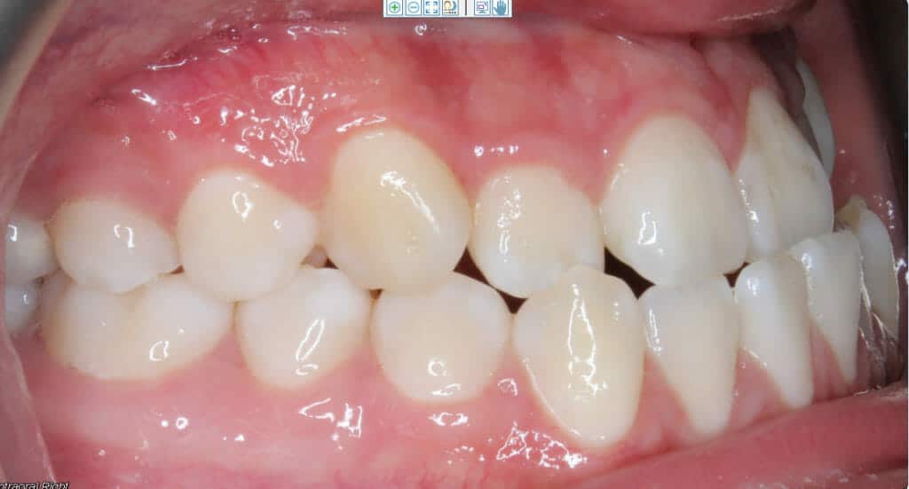 showing of teeth that has an underbite with a cross bite