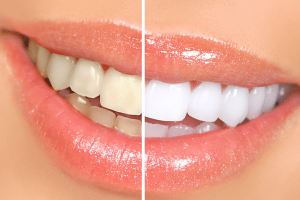 A closeup of a smiling mouth showing teeth with half the image showing yellowed teeth and the other half showing whitened teeth from teeth whitening services.