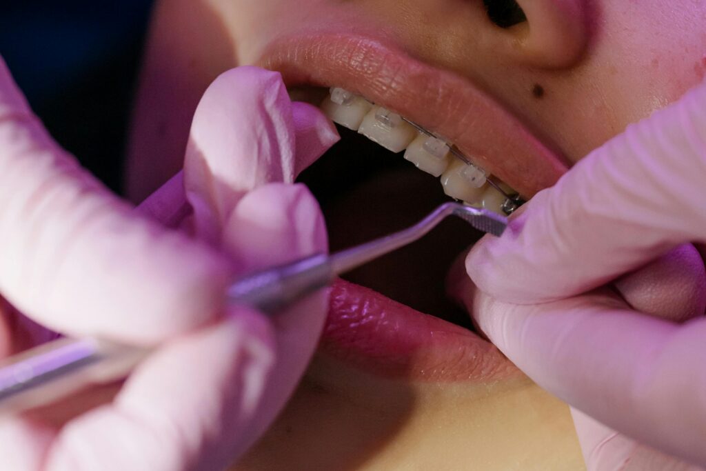 An orthodontist works on a dental bracket close up.