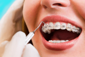 Close up image of orhodontist working on woman's braces