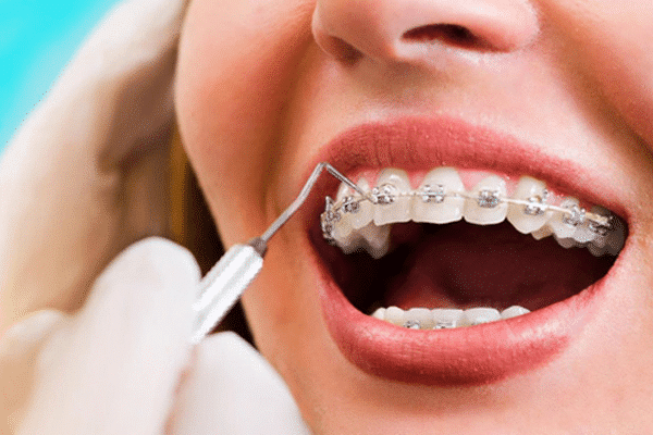 up close image of orthodontic working on woman's braces